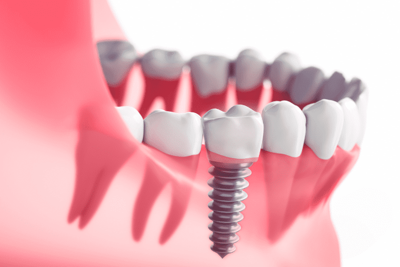 השתלת שיניים היא הפתרון הפופולרי להחלפת שיניים